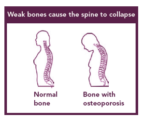 Depictions of a normal spine and a spine with osteoporosis